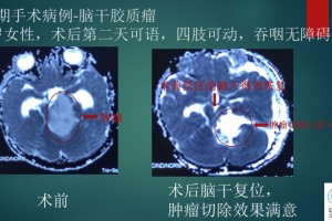 儿童脑干胶质瘤可以手术吗