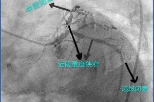 【新闻快递】心内二科专家成功救治极高危冠脉多支病变患者