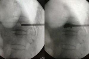 【健康科普】白叟椎体骨折多是骨质疏松惹的祸