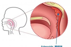 追寻孩子打呼噜的首恶——腺样体肥壮疾病